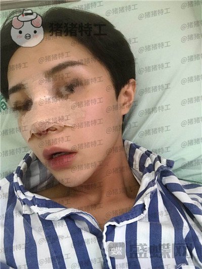 成都西区医院,车红昌,鼻部手术,案例,价格,