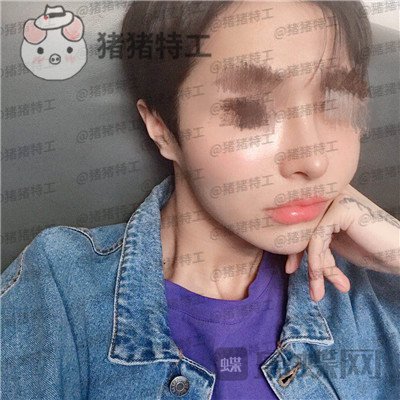 成都西区医院,车红昌,鼻部手术,案例,价格,