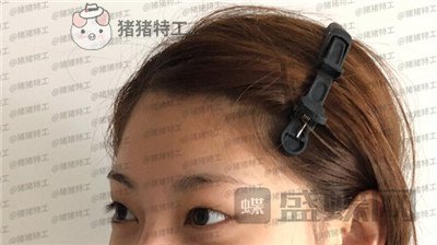杭州美莱,张霞飞,双眼皮,案例,价格,
