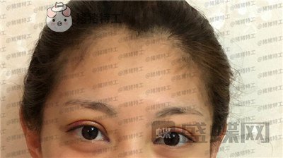 杭州美莱,张霞飞,双眼皮,案例,价格,