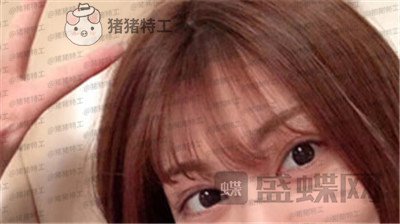 杭州美莱,张霞飞,双眼皮,案例,价格,
