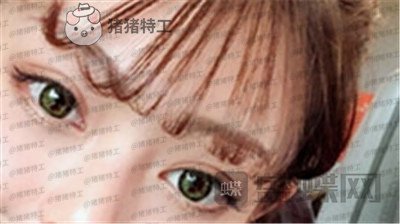 杭州美莱,张霞飞,双眼皮,案例,价格,