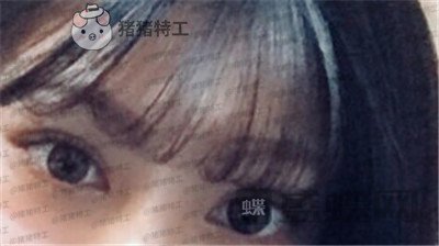 杭州美莱,张霞飞,双眼皮,案例,价格,