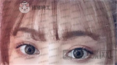 杭州美莱,张霞飞,双眼皮,案例,价格,