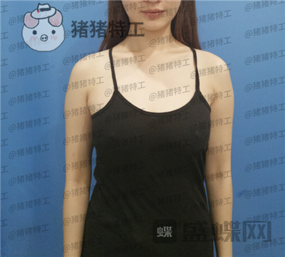 南京美贝尔,张永升,隆胸,案例,价格,