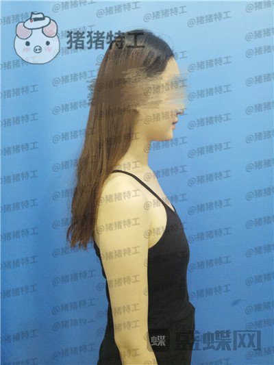 南京美贝尔,张永升,隆胸,案例,价格,