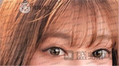 杭州美莱,张霞飞,双眼皮,案例,价格,
