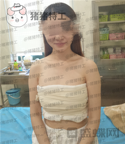 南京美贝尔,张永升,隆胸,案例,价格,