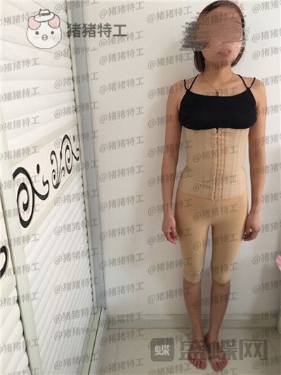 重庆万家燕,王珍祥,吸脂,案例,价格,