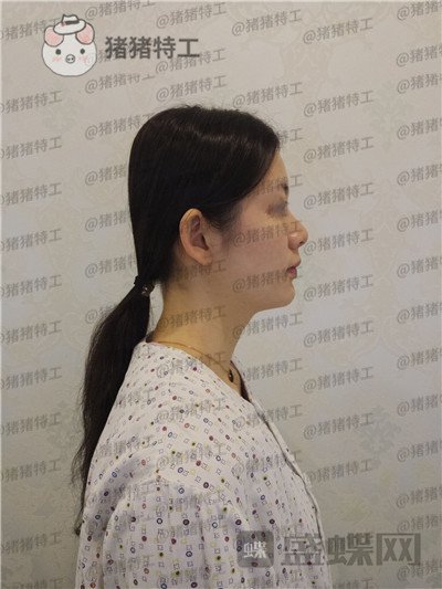 南京美贝尔,黄名斗,鼻部手术,案例,价格,
