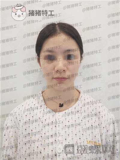 南京美贝尔,黄名斗,鼻部手术,案例,价格,