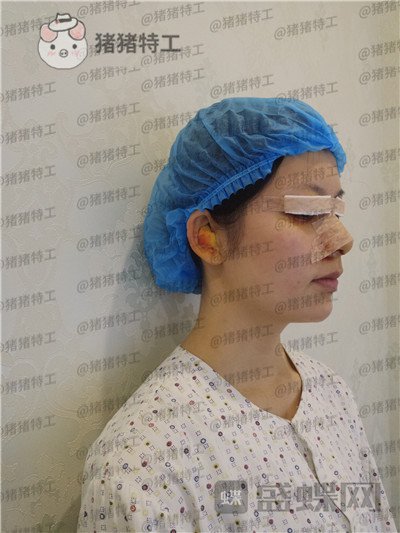 南京美贝尔,黄名斗,鼻部手术,案例,价格,