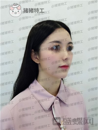 南京美贝尔,黄名斗,鼻部手术,案例,价格,