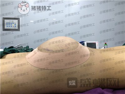 深圳仁安雅,苗春来,丰臀,案例,价格,