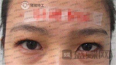 成都素美,杨迪,眼部手术,案例,价格,