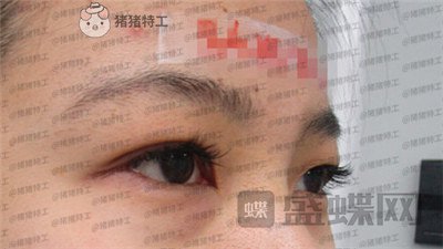 成都素美,杨迪,眼部手术,案例,价格,