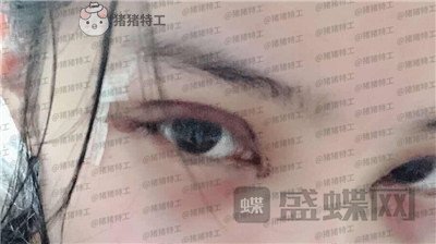 成都素美,杨迪,眼部手术,案例,价格,