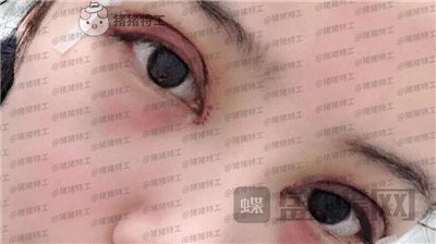 成都素美,杨迪,眼部手术,案例,价格,