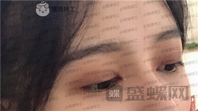 成都素美,杨迪,眼部手术,案例,价格,