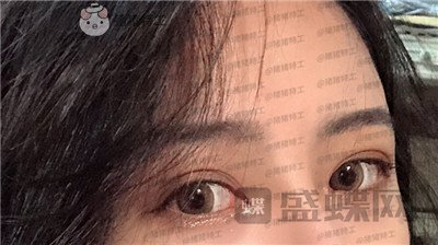 成都素美,杨迪,眼部手术,案例,价格,