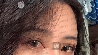 成都素美,杨迪,眼部手术,案例,价格,