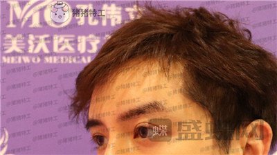 长沙美沃,孔伟立,双眼皮修复,案例,价格,