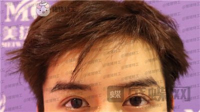 长沙美沃,孔伟立,双眼皮修复,案例,价格,