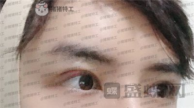 长沙美沃,孔伟立,双眼皮修复,案例,价格,