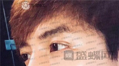 长沙美沃,孔伟立,双眼皮修复,案例,价格,