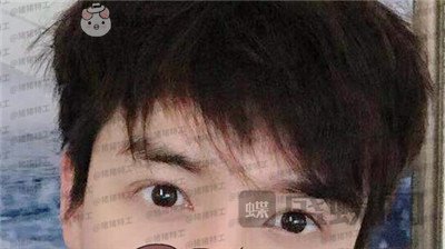 长沙美沃,孔伟立,双眼皮修复,案例,价格,