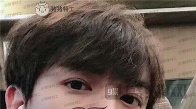 长沙美沃,孔伟立,双眼皮修复,案例,价格,