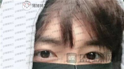 长沙美沃,孔伟立,双眼皮修复,案例,价格,