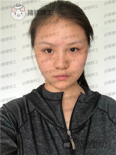 兰州亚韩,李军梅,隆鼻,案例,价格,