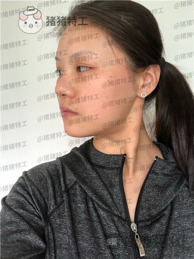 兰州亚韩,李军梅,隆鼻,案例,价格,