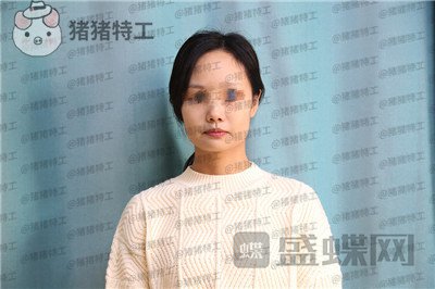 沈阳杏林,朱石江,下颌角磨骨,案例,价格,