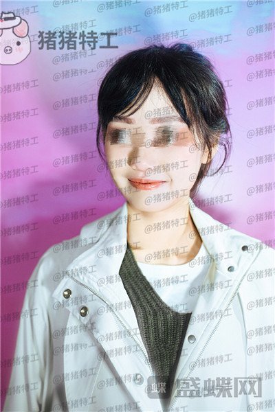 沈阳杏林,朱石江,下颌角磨骨,案例,价格,