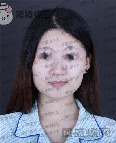 福州,爱美尔,黄振银,隆鼻,案例,价格,
