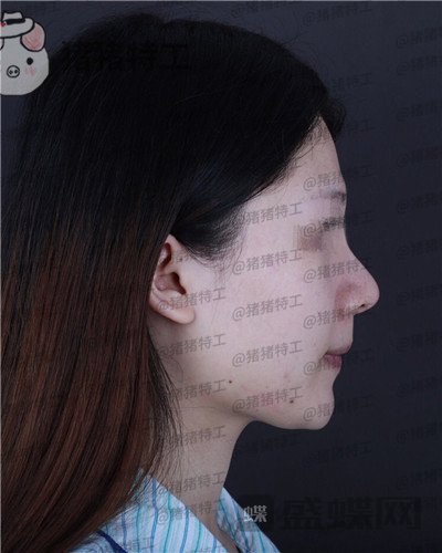 福州,爱美尔,黄振银,隆鼻,案例,价格,