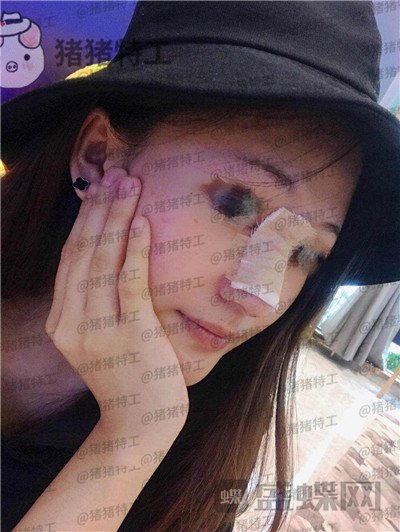 福州,爱美尔,黄振银,隆鼻,案例,价格,
