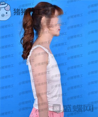 郑州集美,刘德辉,隆胸,案例,价格,