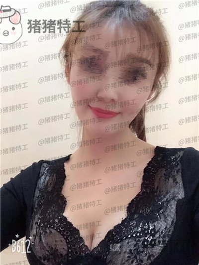 郑州集美,刘德辉,隆胸,案例,价格,