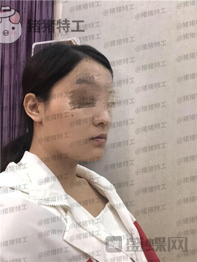 上海愉悦美联臣,曹栋弼,下颌角整形,案例,价格,