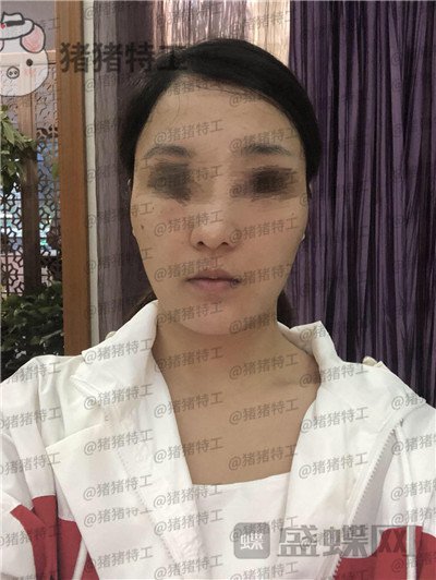 上海愉悦美联臣,曹栋弼,下颌角整形,案例,价格,