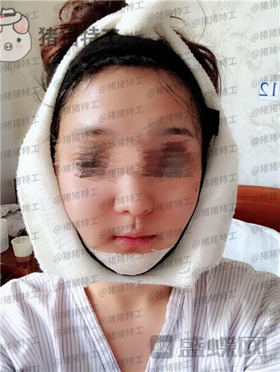 上海愉悦美联臣,曹栋弼,下颌角整形,案例,价格,