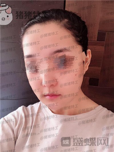 上海愉悦美联臣,曹栋弼,下颌角整形,案例,价格,