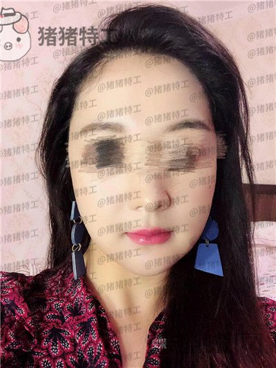 上海愉悦美联臣,曹栋弼,下颌角整形,案例,价格,