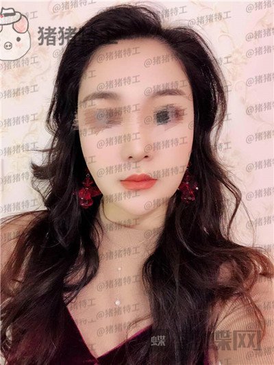 上海愉悦美联臣,曹栋弼,下颌角整形,案例,价格,