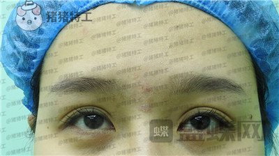北京百达丽,上海九院,苏婷,双眼皮,修复,案例,价格,