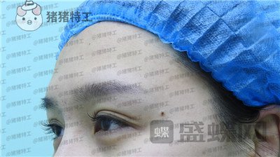 北京百达丽,上海九院,苏婷,双眼皮,修复,案例,价格,
