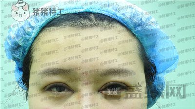 北京百达丽,上海九院,苏婷,双眼皮,修复,案例,价格,